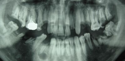 26 ans toutes ses dents    a8z56l - Eugenol