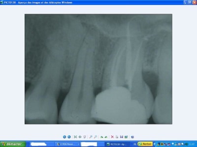 26postop sqas0w - Eugenol