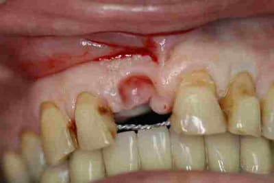 2ansaprès avt implant ol2juu - Eugenol