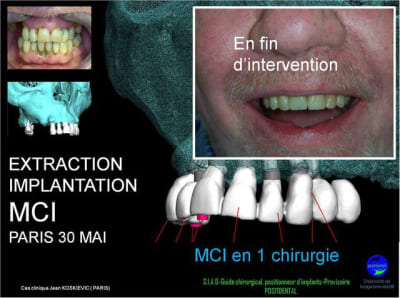 30 mai mci cradk2 - Eugenol