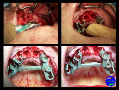3 extraction mci bridge provisoire avec armature m tal rikyvm - Eugenol