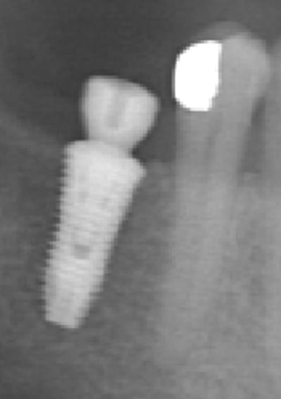 3 mois post op ozkdku - Eugenol