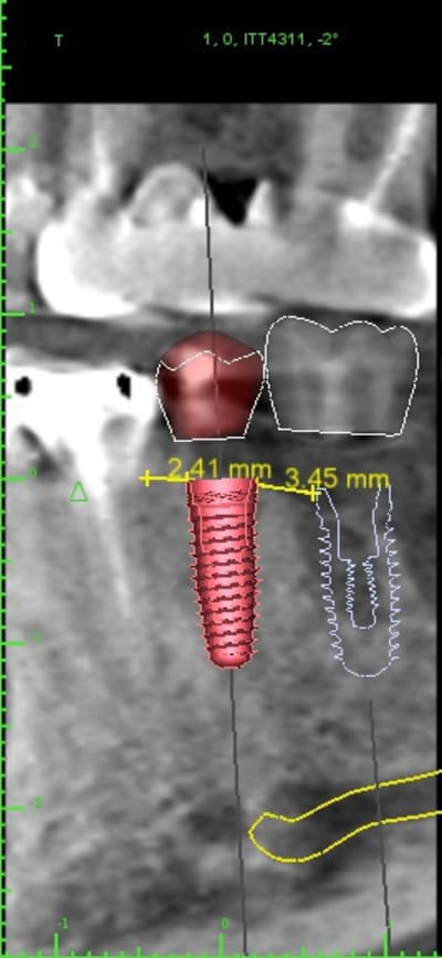 3implants0 implant view gz0ewo - Eugenol