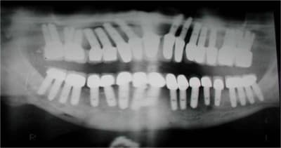 40 implants r4jh8o - Eugenol