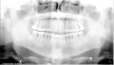 4141pano pre op f2flqs - Eugenol