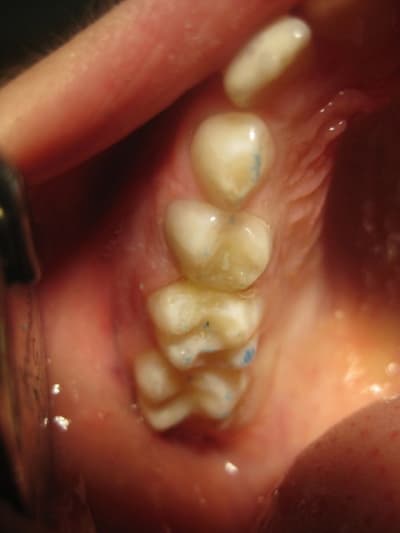 54 et 55 et sealant sur 16 in6hd7 - Eugenol