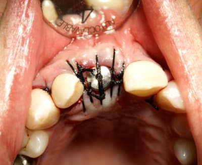 5bis sutures qrazcr - Eugenol