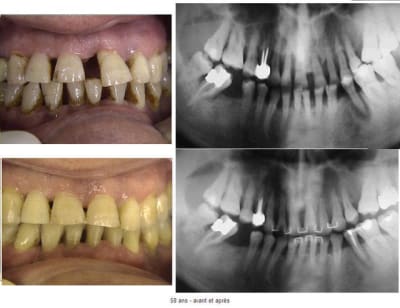 7406 avant apres h4bupo - Eugenol