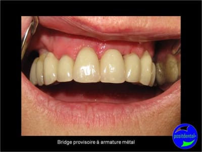 7 extraction mci bridge provisoire avec armature m tal f5kxi9 - Eugenol