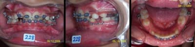 Abd ressort 2 mg2ndd - Eugenol