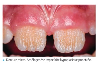 Amélogénèse imparfaite dzbamr - Eugenol