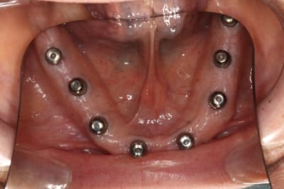 Bas   8 implants  ungdni - Eugenol