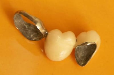 Bridge collé mixte 4 psxk4d - Eugenol