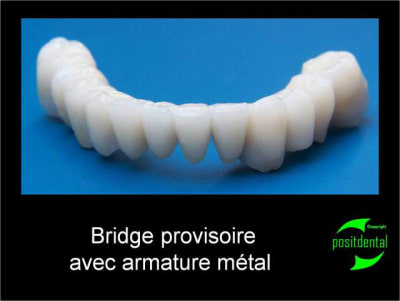Bridge provisoire positdental 2 mno8l2 - Eugenol