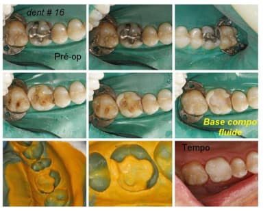 C onlay prep 16 aggebk - Eugenol