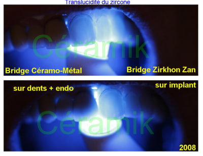 Ccm vs zircone  2008  nbijz0 - Eugenol