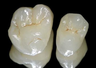 Cerec 15 16 npalu2 - Eugenol