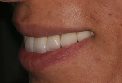 Close up smile lateral left 2 p2lft3 - Eugenol