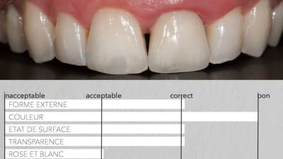 Centrale unitaire zircone translucide ht ceramique feldspathique noritake chappe anatomique transparence mimetisme - Eugenol