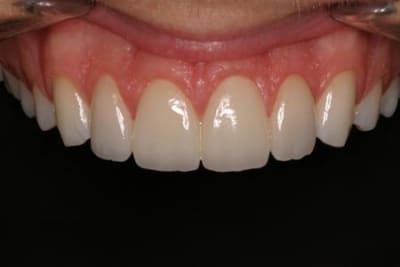 Cerec 13 23 kykgh1 - Eugenol