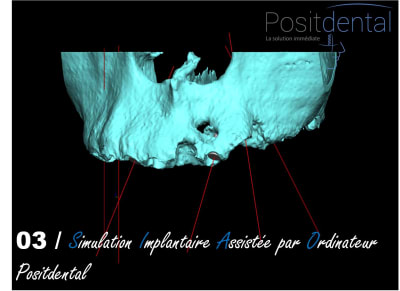 Chirurgie guidée   mise en charge immédiate 003 latl3i - Eugenol