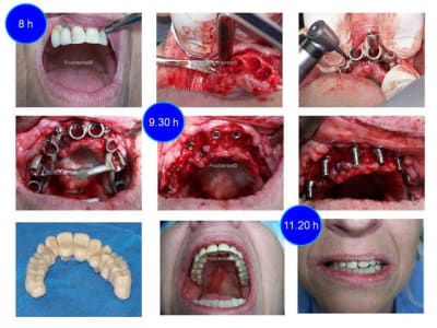 Chirurgie guid e et mise en charge imm diate zrvr6t - Eugenol