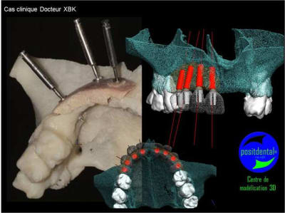 Comment simplifier et fiabiliser les greffes cas clinique dr pxav 7 o0oczb - Eugenol