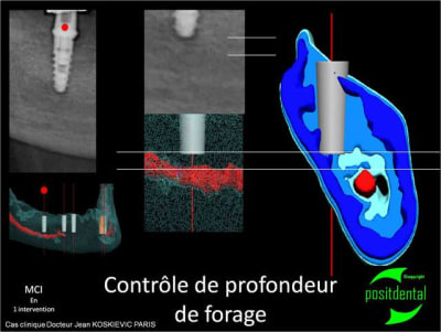 Contr le de profondeur de forage  - Eugenol