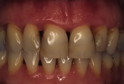 Copie de apres brossage  exvd16 - Eugenol