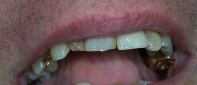 Copie de 2013 03 13 positdental 002 zsx5tz - Eugenol