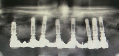 Copie de 2013 03 13 positdental 075 tsjaru - Eugenol