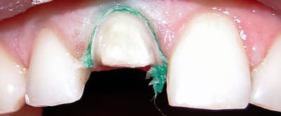 Correction des limites vestibulaires et proximales zlxera - Eugenol