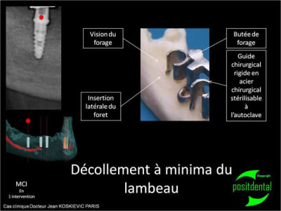 D collement   minima du lambeau a6xkp7 - Eugenol