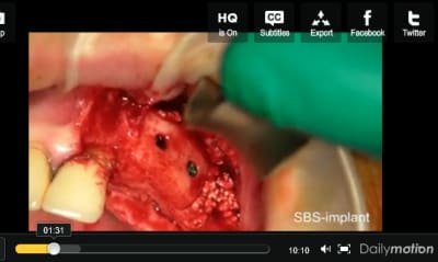Dailymotion   bone grafting part 2 wg9sbx - Eugenol