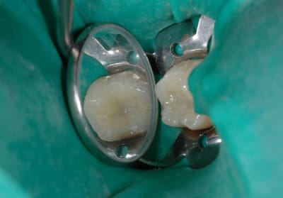 Dentine2 qjpodq - Eugenol