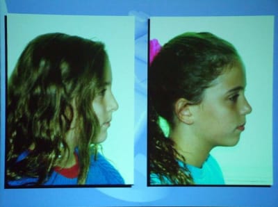 Deux soeurs avant ttt pcfhzt - Eugenol