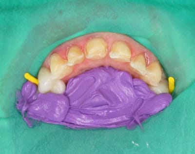 Digue facettes oasn5v - Eugenol
