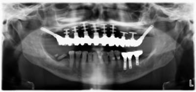 Diskimplant dcibpy - Eugenol