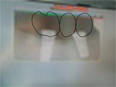 Distance entre 2 implants 3 pxsfwo - Eugenol