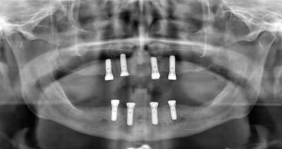 Doptd azcrcr - Eugenol