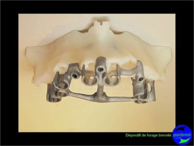 Eimci et canine incluse positdental 05 lwqrco - Eugenol