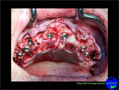 Eimci et canine incluse positdental 10 c6uvvc - Eugenol