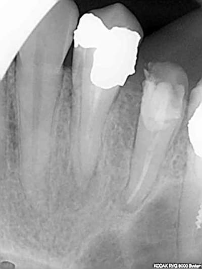 Endo1 upafhx - Eugenol