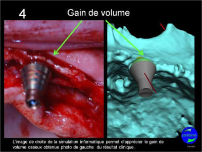 Expansion  condensation guid e  positdental 05 rjo7hk - Eugenol
