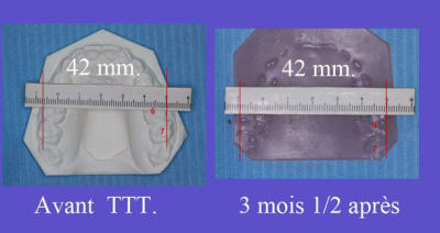 Expansion bis ygmb2n - Eugenol