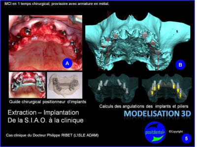 Extraction   implantation   mod lisation 3d positdental  15 omtsfo - Eugenol