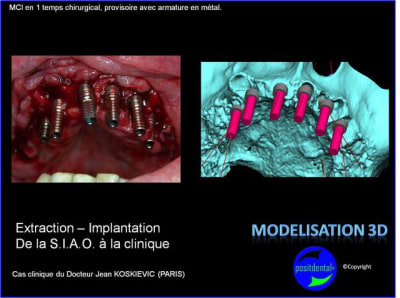 Extraction   implantation   mod lisation 3d positdental  4 iveznn - Eugenol