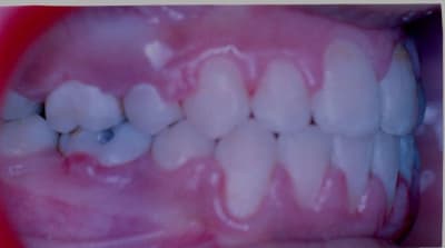 Fin de traitement pd lb2hid - Eugenol