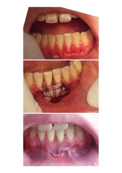 Gec xexili - Eugenol