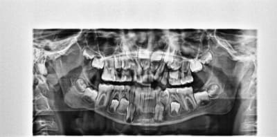 Gharsalli bacem voghlg - Eugenol